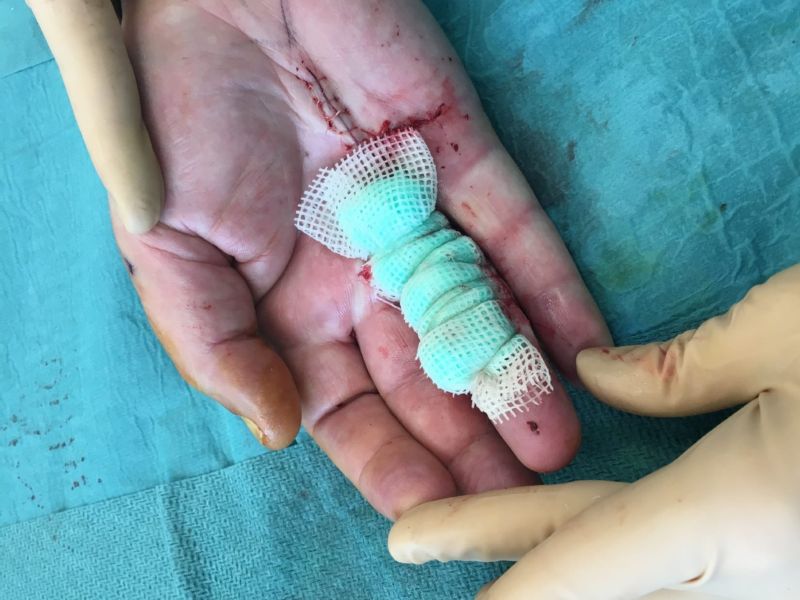 Hand affected by Dupuytren's disease during the Dermofasciectomy, with tie-over dressing to keep the skin graft in place
